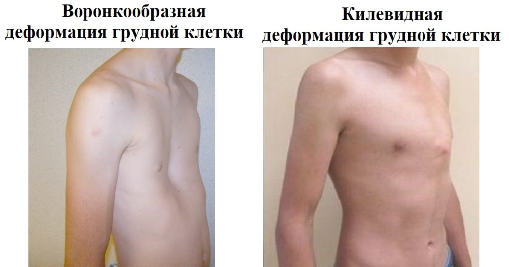 У меня деформация грудной клетки(Килевидная) берут ли с этим в армию?